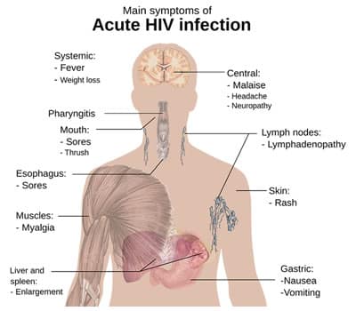 Die Symptome von HIV